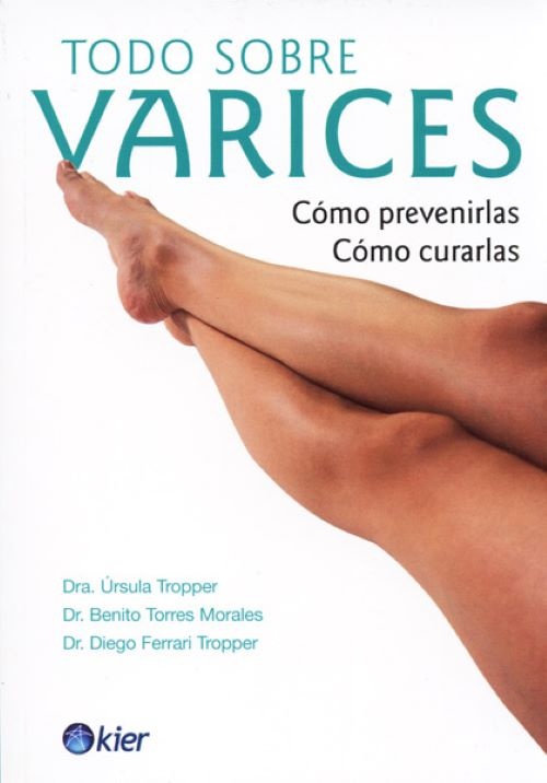 Todo sobre varices